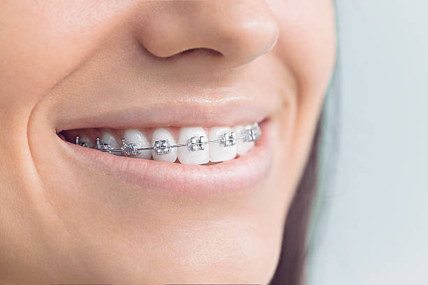 Best Traditional Braces  in Hudson Lake, IN